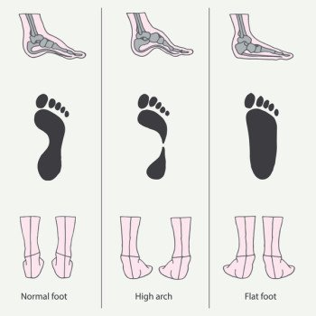 How to determine flat feet?