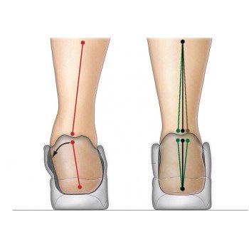 What is foot hyperpronation?