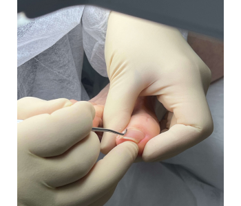 Онихокриптоз или вросший ноготь: что нужно знать?