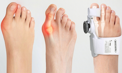 Кісточки на ногах: як лікувати – Olvi