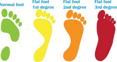 Flat feet in children photo - Olvi.ua blog