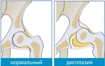 What is hip dysplasia? - Olvi.ua blog