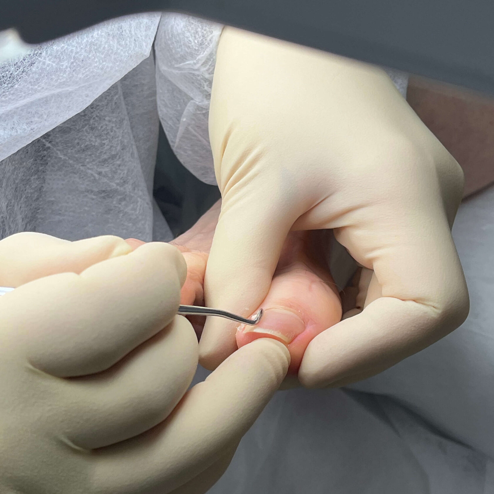 Onychocryptosis or ingrown toenail: what you need to know? - Olvi