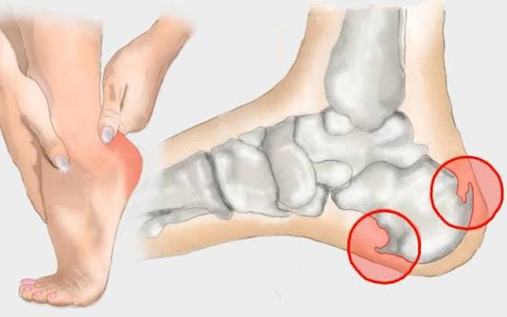 What Are Heel Spurs? Symptoms and Pathophysiology - Olvi